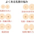 乳房が両方あるいは片方だけ垂れてきた...垂れる原因と対処法