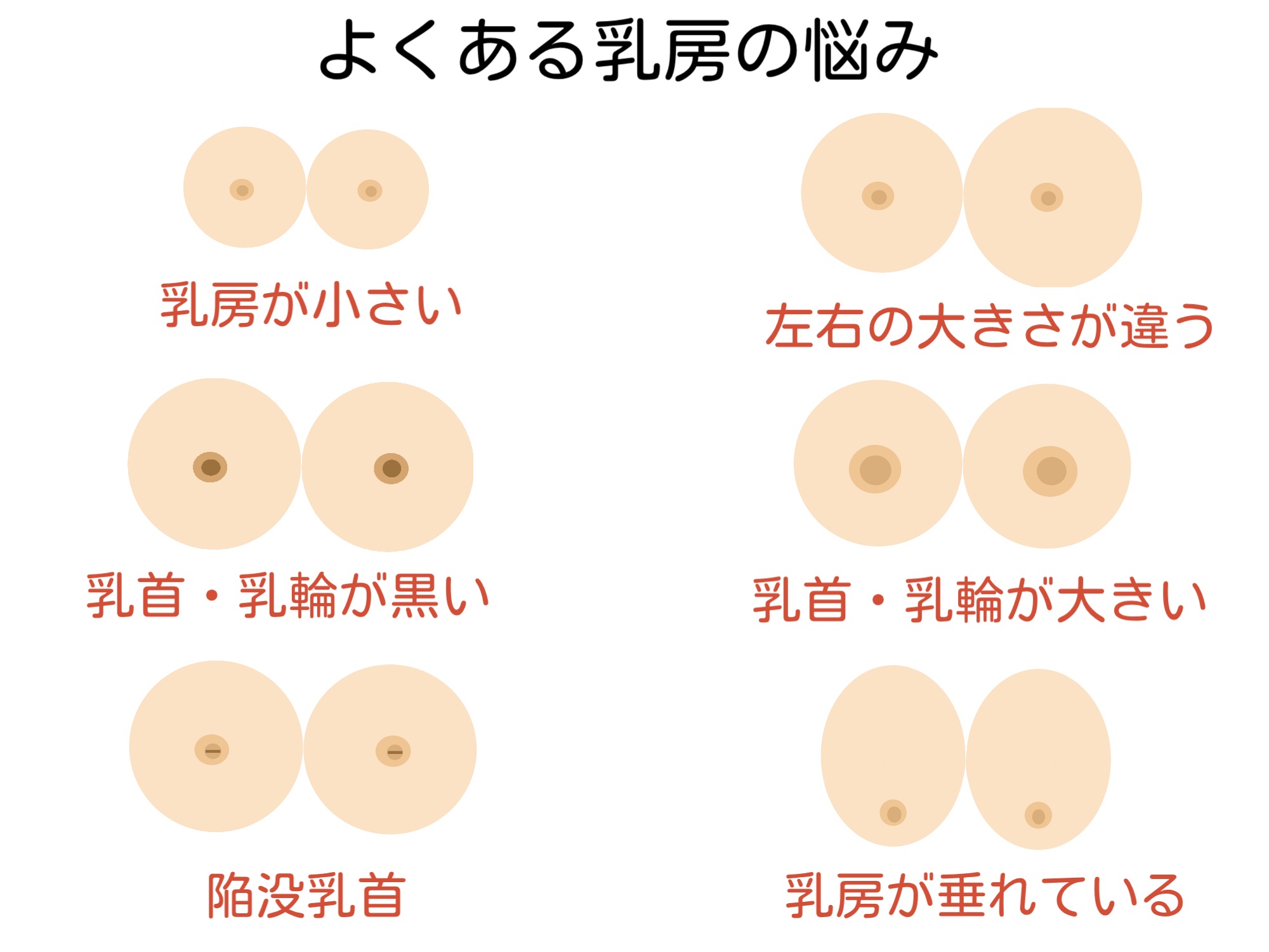 乳房が小さい、乳房の左右の大きさが違う、乳首・乳輪が黒い大きい、陥没乳首、乳房が垂れている