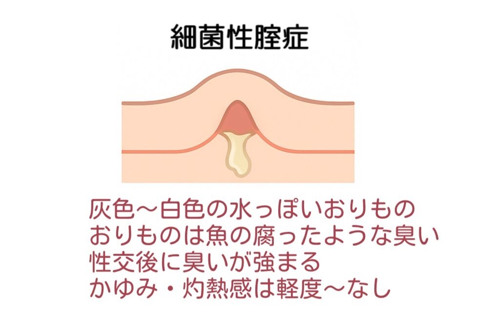 細菌性膣症の特徴(写真・イラスト)