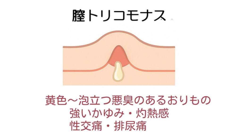 膣トリコモナスの特徴(写真・イラスト)